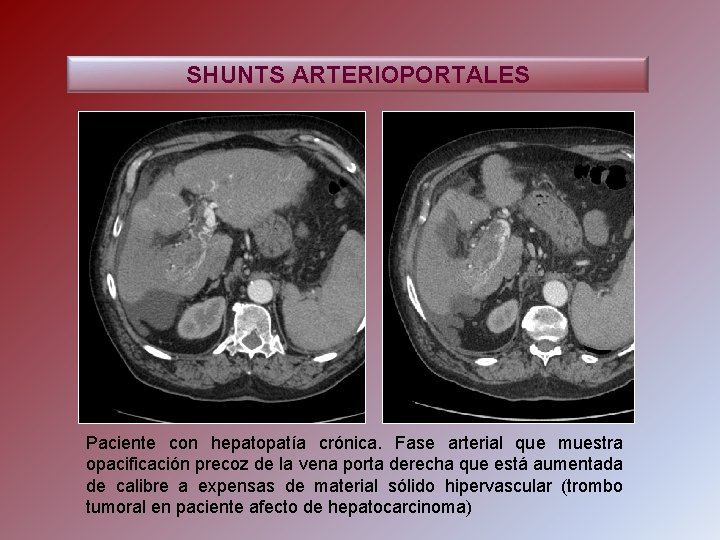 SHUNTS ARTERIOPORTALES Paciente con hepatopatía crónica. Fase arterial que muestra opacificación precoz de la