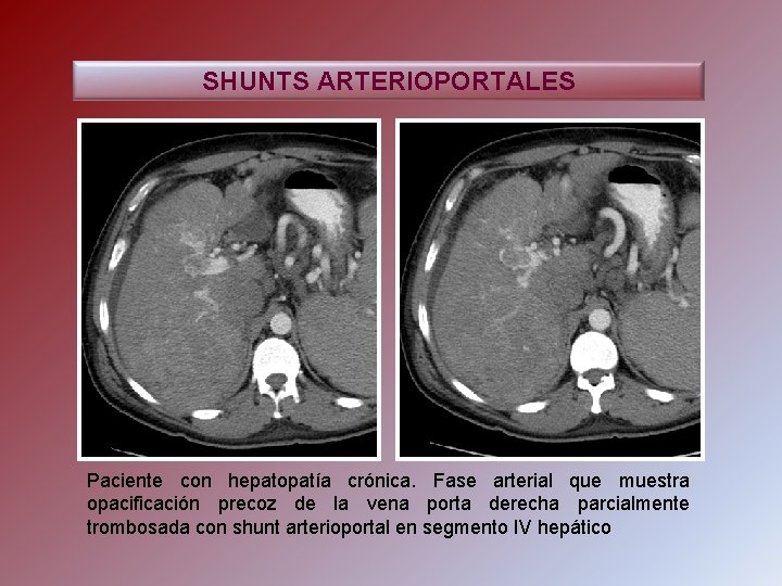 SHUNTS ARTERIOPORTALES Paciente con hepatopatía crónica. Fase arterial que muestra opacificación precoz de la