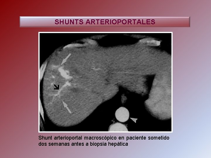 SHUNTS ARTERIOPORTALES Shunt arterioportal macroscópico en paciente sometido dos semanas antes a biopsia hepática