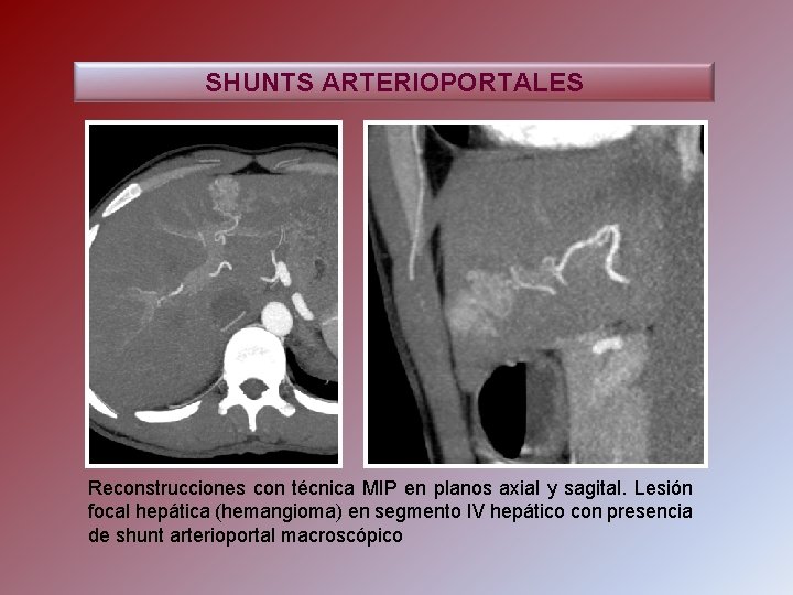SHUNTS ARTERIOPORTALES Reconstrucciones con técnica MIP en planos axial y sagital. Lesión focal hepática