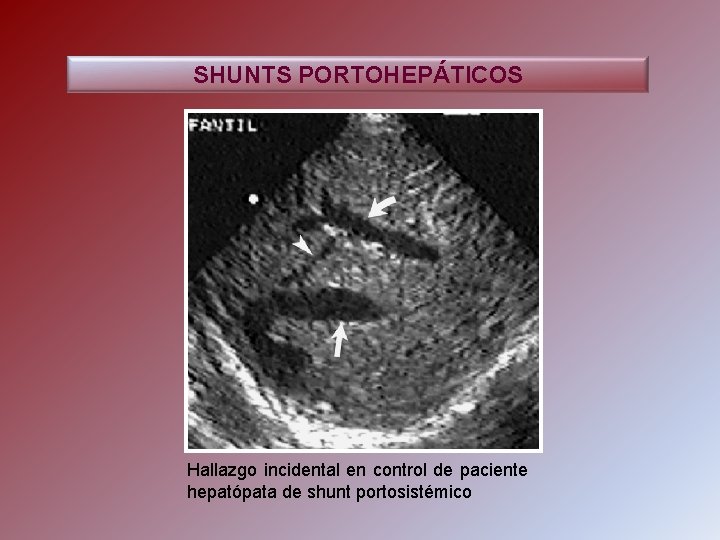 SHUNTS PORTOHEPÁTICOS Hallazgo incidental en control de paciente hepatópata de shunt portosistémico 