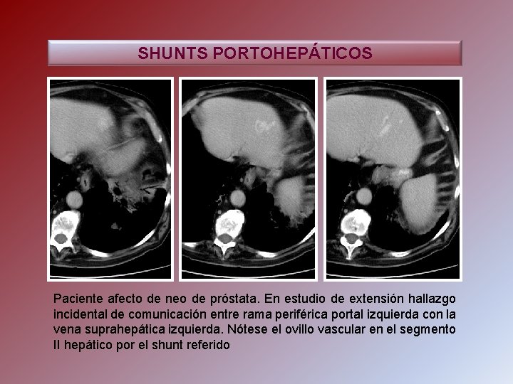 SHUNTS PORTOHEPÁTICOS Paciente afecto de neo de próstata. En estudio de extensión hallazgo incidental