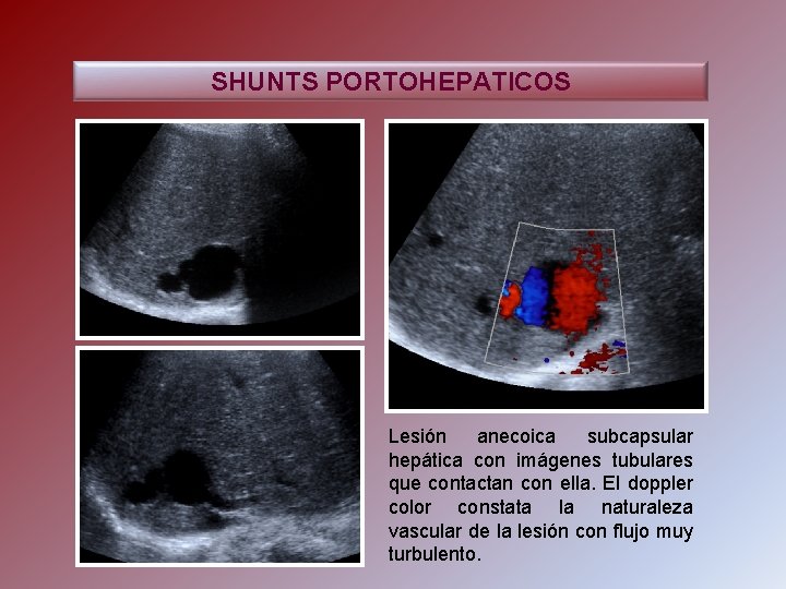 SHUNTS PORTOHEPATICOS Lesión anecoica subcapsular hepática con imágenes tubulares que contactan con ella. El
