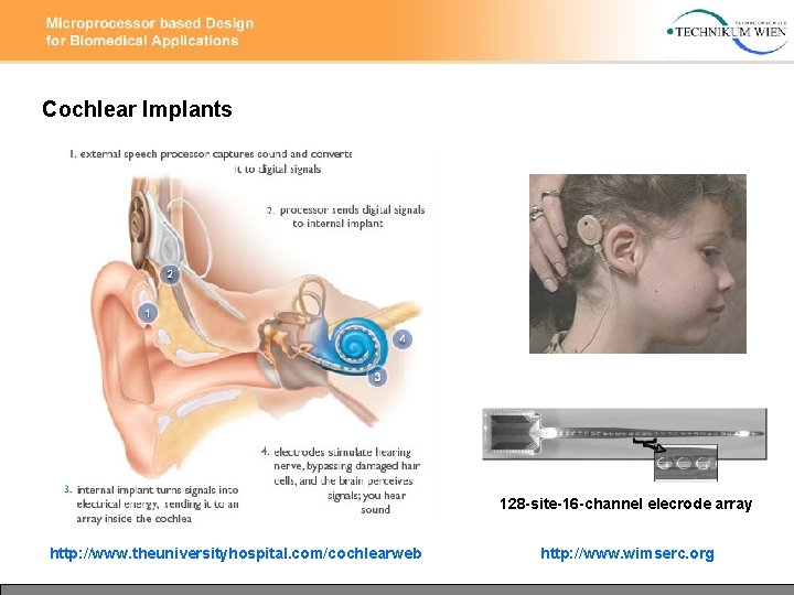 Cochlear Implants 128 -site-16 -channel elecrode array http: //www. theuniversityhospital. com/cochlearweb http: //www. wimserc.