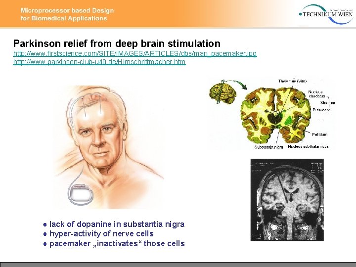 Parkinson relief from deep brain stimulation http: //www. firstscience. com/SITE/IMAGES/ARTICLES/dbs/man_pacemaker. jpg http: //www. parkinson-club-u