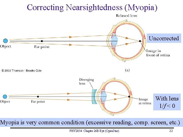 Correcting Nearsightedness (Myopia) Uncorrected With lens 1/f < 0 Myopia is very common condition