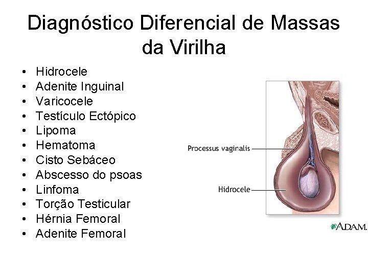 Diagnóstico Diferencial de Massas da Virilha • • • Hidrocele Adenite Inguinal Varicocele Testículo