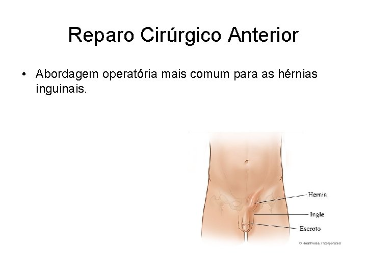 Reparo Cirúrgico Anterior • Abordagem operatória mais comum para as hérnias inguinais. 