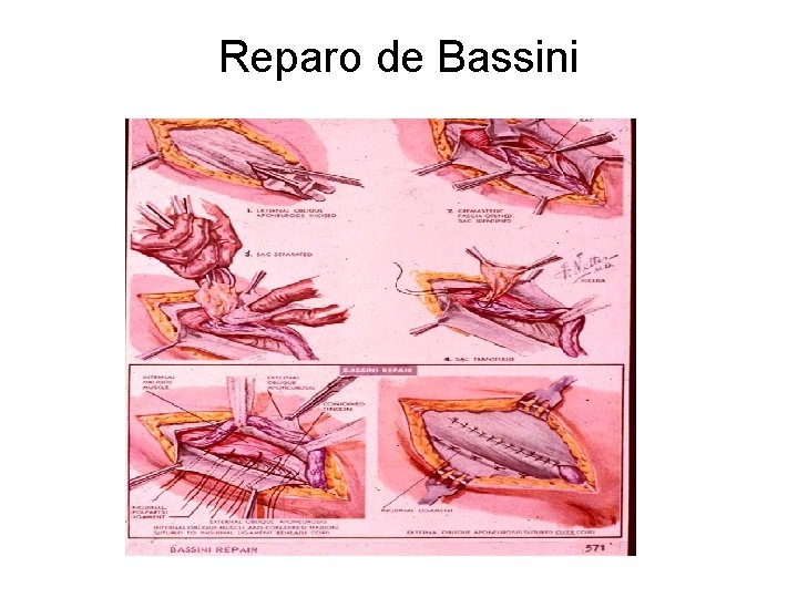 Reparo de Bassini 