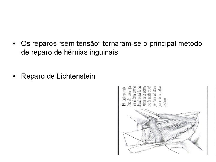  • Os reparos “sem tensão” tornaram-se o principal método de reparo de hérnias