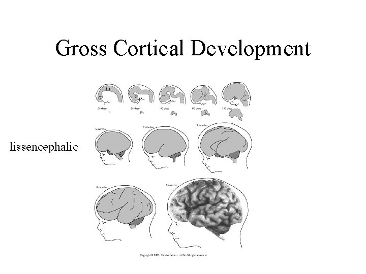 Gross Cortical Development lissencephalic 