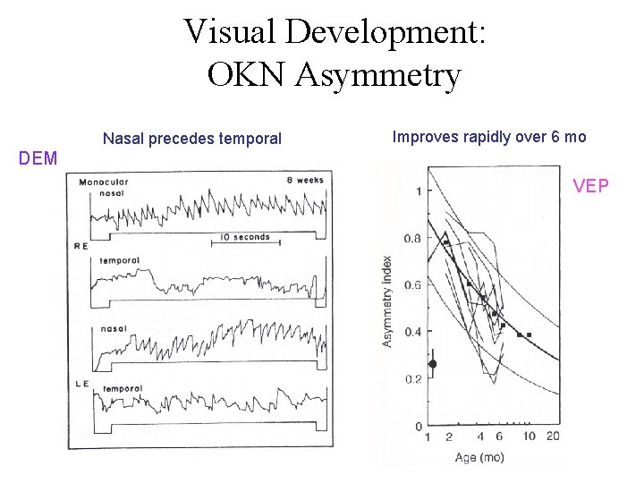 Visual Development: OKN Asymmetry Nasal precedes temporal Improves rapidly over 6 mo DEM VEP