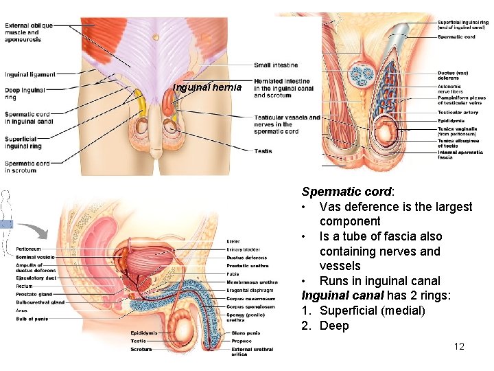 Inguinal hernia Spermatic cord: • Vas deference is the largest component • Is a