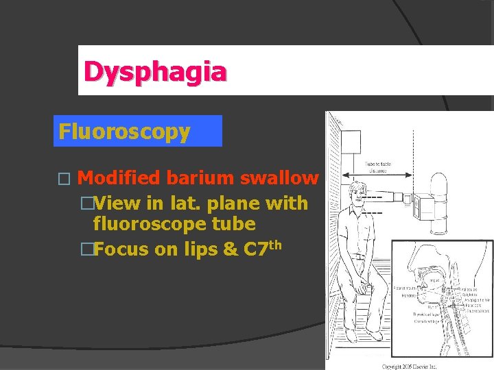 Dysphagia Fluoroscopy � Modified barium swallow �View in lat. plane with fluoroscope tube �Focus