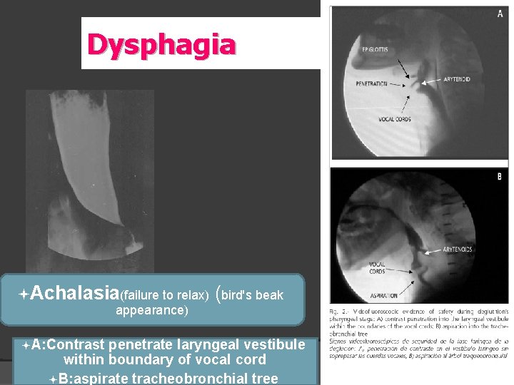 Dysphagia ªAchalasia(failure to relax) (bird's beak appearance) ªA: Contrast penetrate laryngeal vestibule within boundary