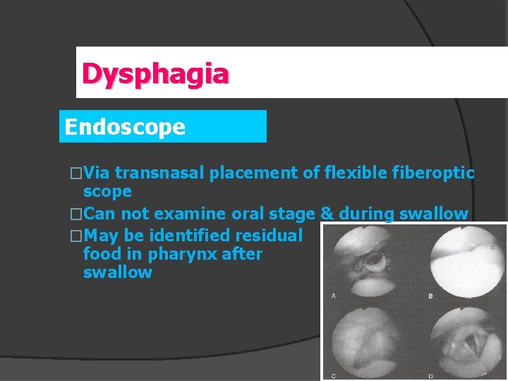 Dysphagia Endoscope �Via transnasal placement of flexible fiberoptic scope �Can not examine oral stage