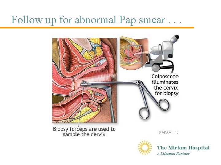 Follow up for abnormal Pap smear. . . 