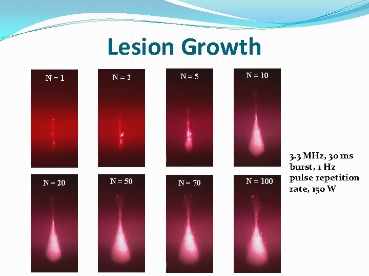 Lesion Growth N=1 N = 20 N=2 N = 50 N=5 N = 70