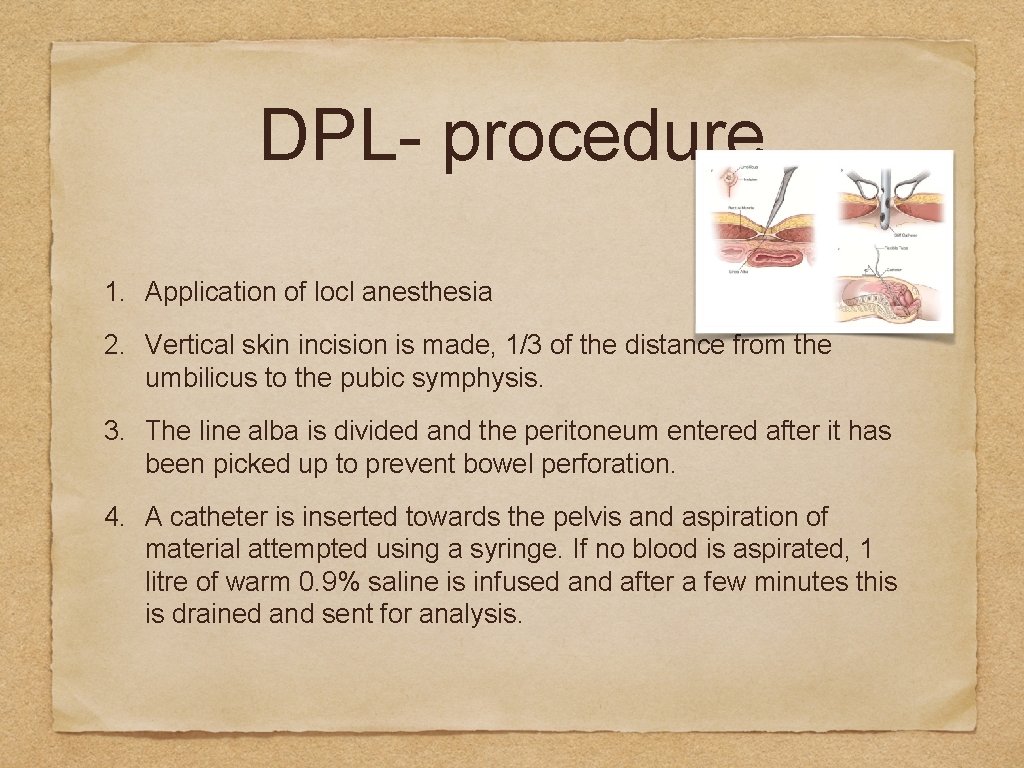 DPL- procedure 1. Application of locl anesthesia 2. Vertical skin incision is made, 1/3