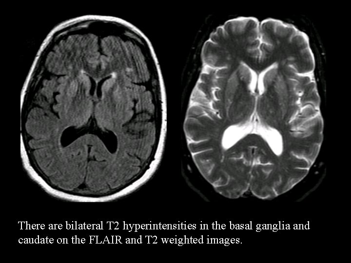 There are bilateral T 2 hyperintensities in the basal ganglia and caudate on the