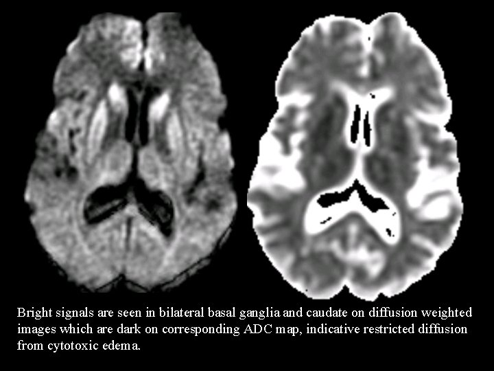 Bright signals are seen in bilateral basal ganglia and caudate on diffusion weighted images