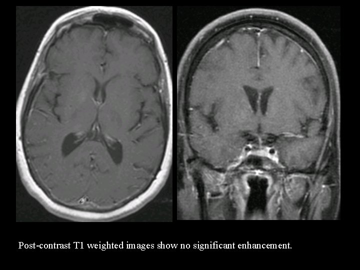 Post-contrast T 1 weighted images show no significant enhancement. 