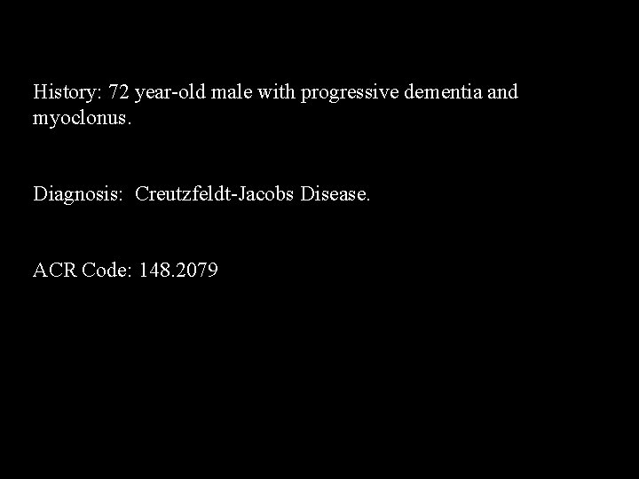 History: 72 year-old male with progressive dementia and myoclonus. Diagnosis: Creutzfeldt-Jacobs Disease. ACR Code: