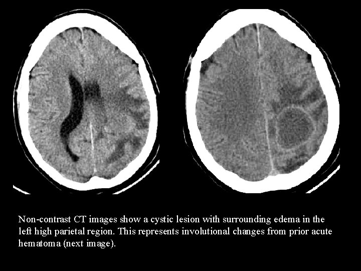 Non-contrast CT images show a cystic lesion with surrounding edema in the left high