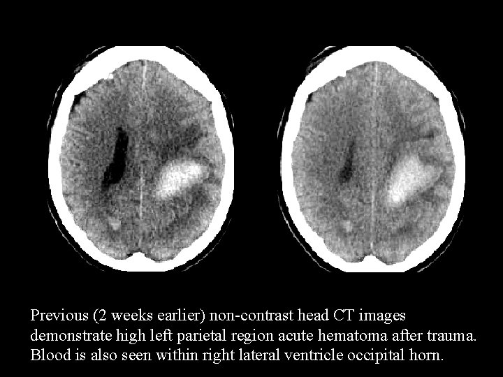 Previous (2 weeks earlier) non-contrast head CT images demonstrate high left parietal region acute