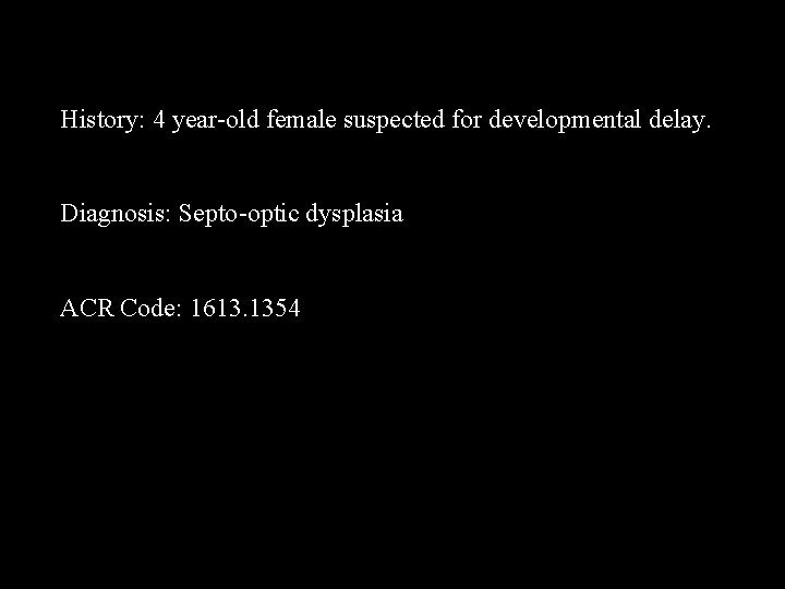 History: 4 year-old female suspected for developmental delay. Diagnosis: Septo-optic dysplasia ACR Code: 1613.