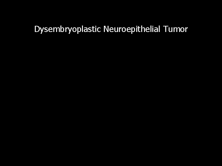 Dysembryoplastic Neuroepithelial Tumor 