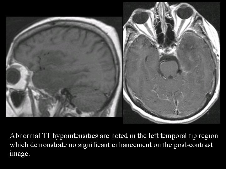 Abnormal T 1 hypointensities are noted in the left temporal tip region which demonstrate