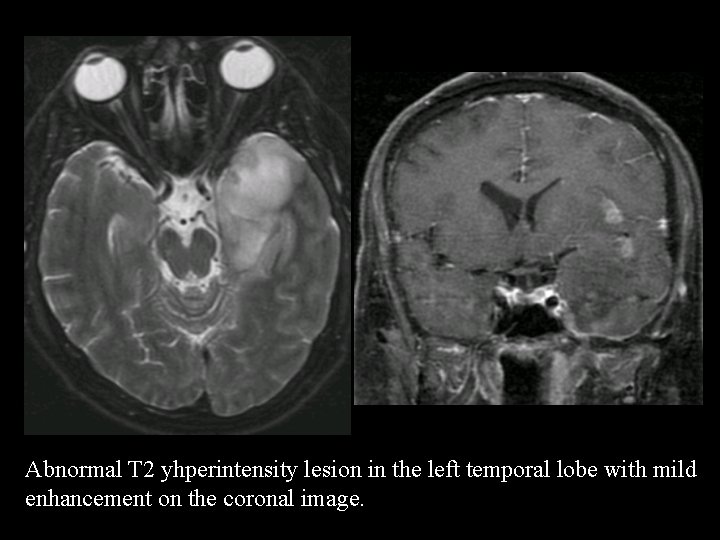 Abnormal T 2 yhperintensity lesion in the left temporal lobe with mild enhancement on