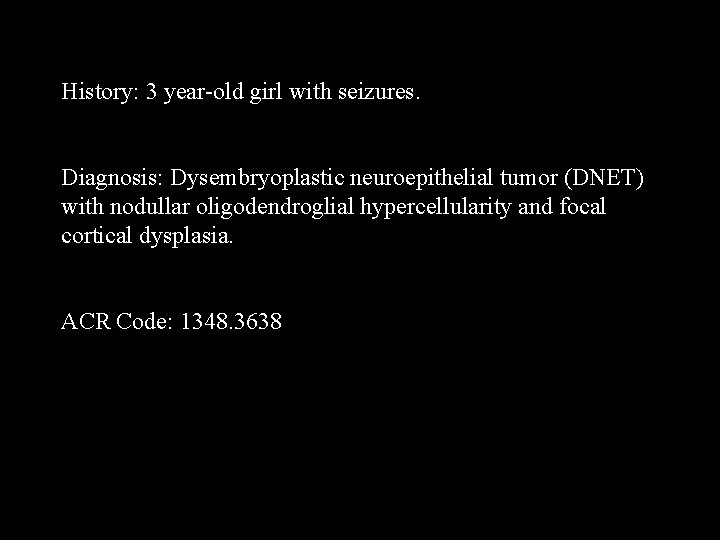 History: 3 year-old girl with seizures. Diagnosis: Dysembryoplastic neuroepithelial tumor (DNET) with nodullar oligodendroglial