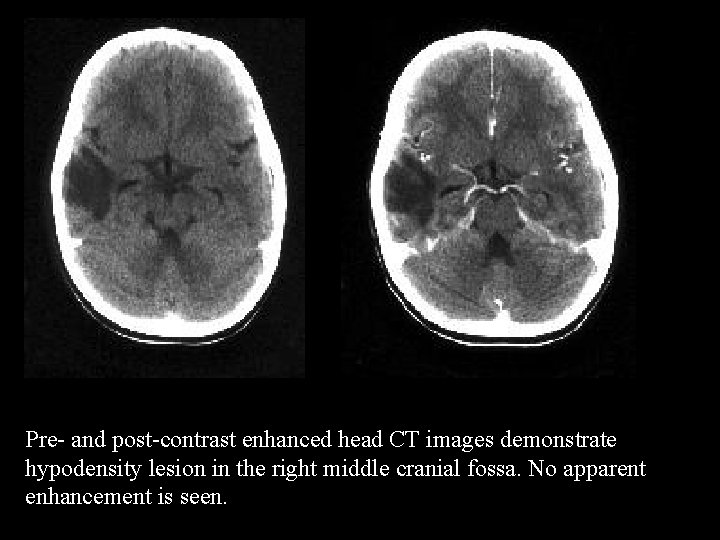 Pre- and post-contrast enhanced head CT images demonstrate hypodensity lesion in the right middle