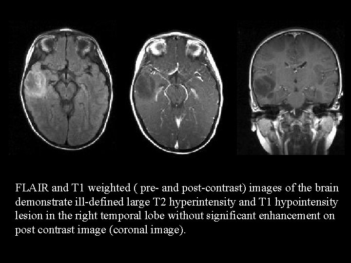 FLAIR and T 1 weighted ( pre- and post-contrast) images of the brain demonstrate