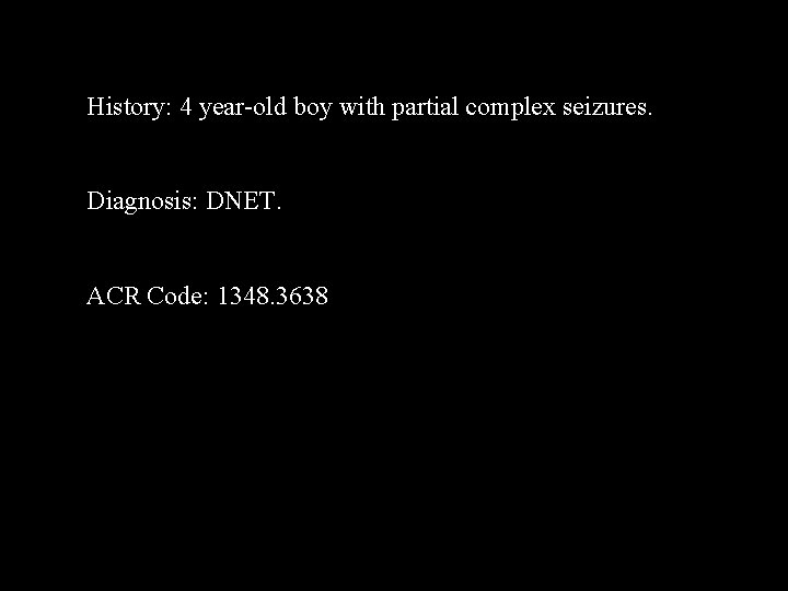 History: 4 year-old boy with partial complex seizures. Diagnosis: DNET. ACR Code: 1348. 3638