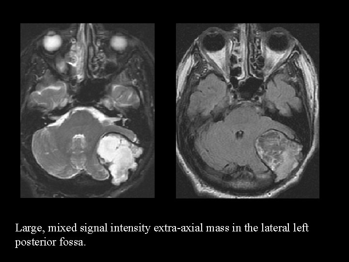 Large, mixed signal intensity extra-axial mass in the lateral left posterior fossa. 