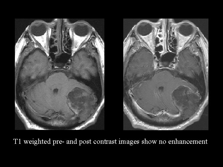 T 1 weighted pre- and post contrast images show no enhancement 