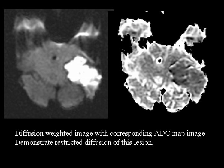 Diffusion weighted image with corresponding ADC map image Demonstrate restricted diffusion of this lesion.