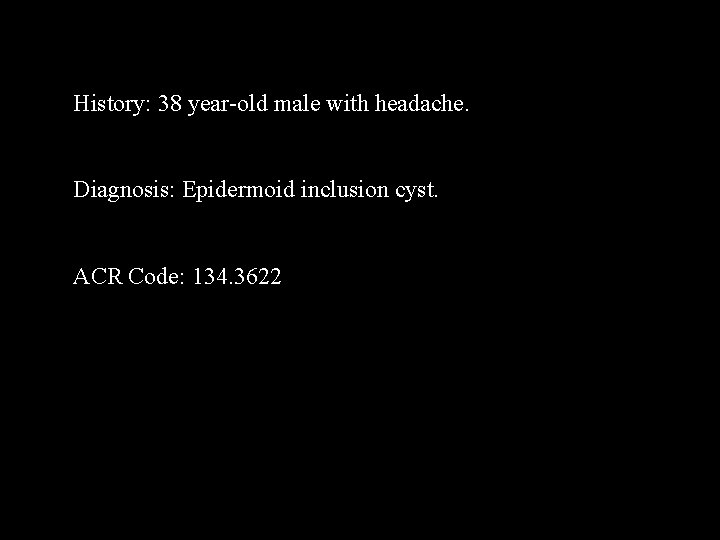 History: 38 year-old male with headache. Diagnosis: Epidermoid inclusion cyst. ACR Code: 134. 3622