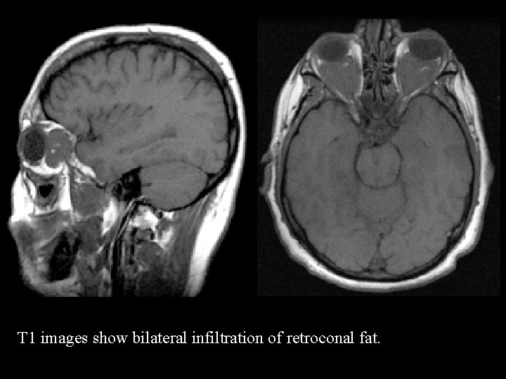 T 1 images show bilateral infiltration of retroconal fat. 