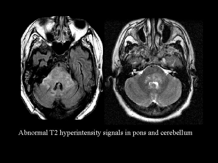 Abnormal T 2 hyperintensity signals in pons and cerebellum 