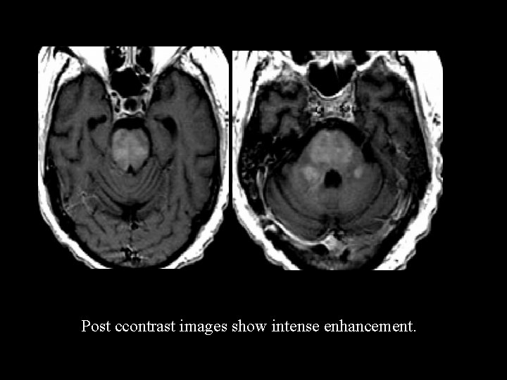 Post ccontrast images show intense enhancement. 