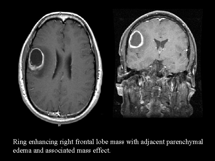 Ring enhancing right frontal lobe mass with adjacent parenchymal edema and associated mass effect.