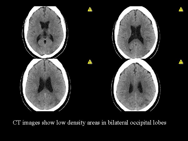 CT images show low density areas in bilateral occipital lobes 