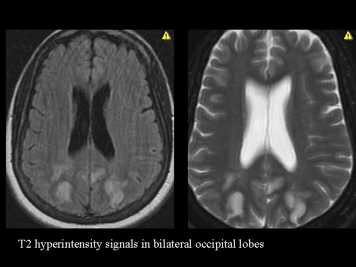 T 2 hyperintensity signals in bilateral occipital lobes 