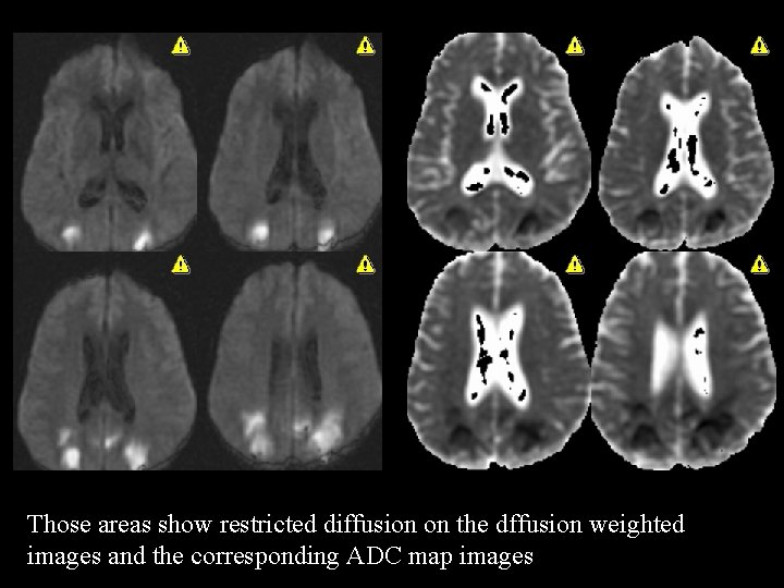 Those areas show restricted diffusion on the dffusion weighted images and the corresponding ADC