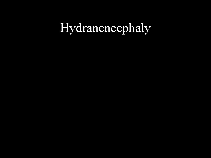 Hydranencephaly 