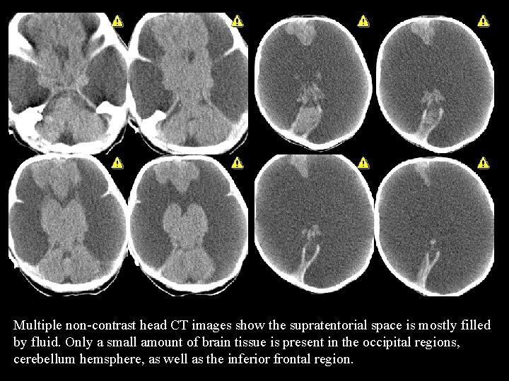 Multiple non-contrast head CT images show the supratentorial space is mostly filled by fluid.